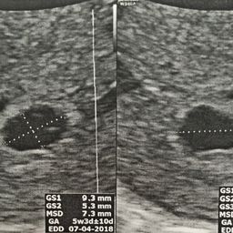 5w5d ultrasound empty sac