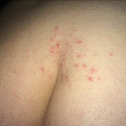 itchy rash on buttocks crack