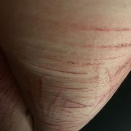 self harm scars on thighs