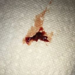 Blood Clot Or Miscarriage Glow Community Blood Clot Or Miscarriage Glow Community