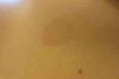 I have this weird dark spot under my boob where my bra wire would