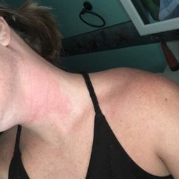 Allergic Reaction To Benadryl Glow Community