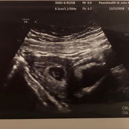 First ultrasound