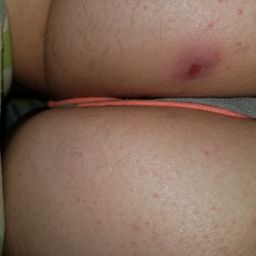 II have this sore on my butt any ideas as to what it is II have