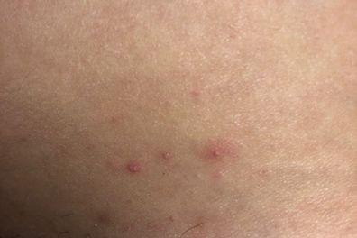 Are these normal bumps on vagina ? They are in the crease of my leg  maybe from my underwear line being there ? - Glow Community