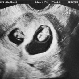 identical twins ultrasound 8 weeks