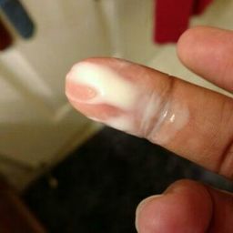 Anyone Ever Had This Type Of Discharge It S Very Thick But Has No Odor I M Not Experiencing Any Itching Burning Or Pain Either It S Very Milky Not Cottage Cheese Like It S Much