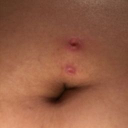 Embedded belly deals button piercing