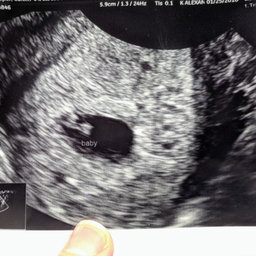 Pictures ultrasound missed twin Detecting Twins
