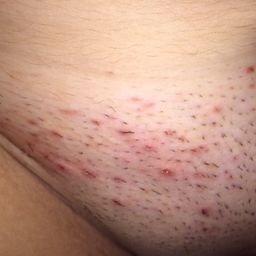 Really Bad Razor Bumps I Read Somewhere That Some People Only Get One Or Two At A Time But This Is Normal For Me And Yes I Exfoliate I Shave Once Downwards With