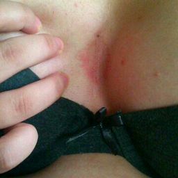 Rash Between Breast not sure of what it could be , it burns at